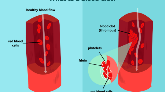 A Blood Clot Can Lead to a Heart Attack, Thrombosis, or a Stroke: Here Are 7 Powerful Blood Thinning Foods You Need