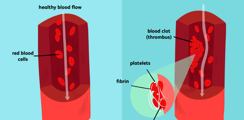 A Blood Clot Can Lead to a Heart Attack, Thrombosis, or a Stroke: Here Are 7 Powerful Blood Thinning Foods You Need